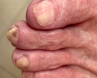 Medical Pedicure in Boise Idaho client with Toe Nail Fungus