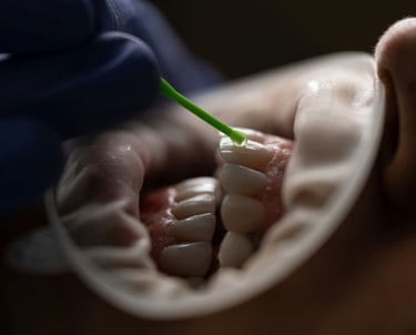 Boca con tratamiento de blanqueamiento dental