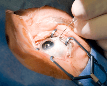 Cataract Surgery