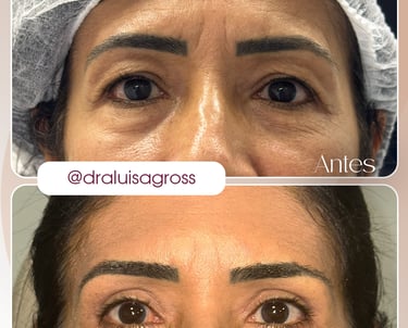 Antes e depois de cirurgia periocular realizada pela Dra. Luisa Gross