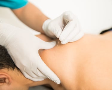 dry needling