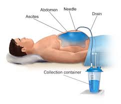 GASTRO FOUNDATION ascites