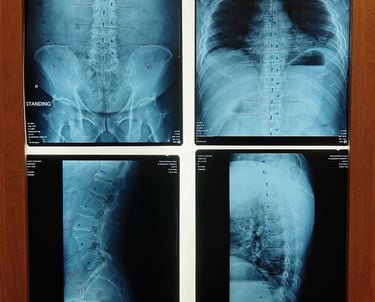Spinal X-rays for chiropractic analysis of back pain and posture at Sinisana Chiropractic.