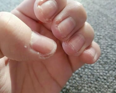 roer unhas