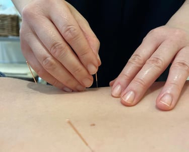 acupuncture needle inserted into patient 