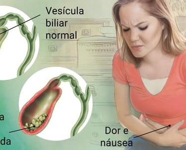 Colecistite aguda. Vesícula inflamada