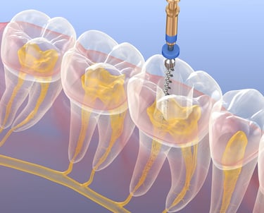 3D dental illustration showing a root canal procedure using an endodontic file to clean tooth pulp.