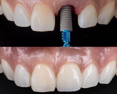 Impianto-dente-davanti-gambara