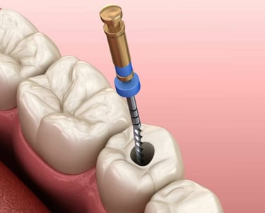 3D illustration of a dental endodontic root canal procedure on a molar tooth.