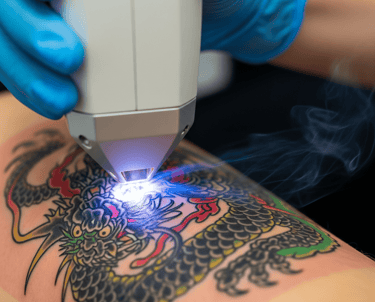 Quitar-mi-tatuaje-con-laser