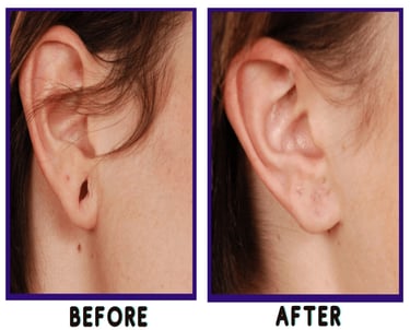 Ear lobe repair in Vadodara: Enhance your beauty with the expertise of the best cosmetic dermatologist