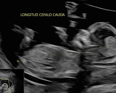 Ultrasonido primer trimestre, ultrasonido genético, ultrasonido cromosómico