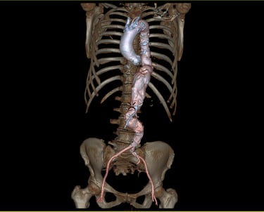 Anévrisme de l'aorte thoracique