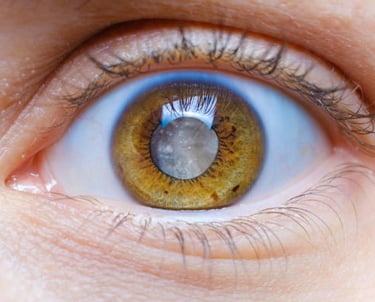 Cataract Eye