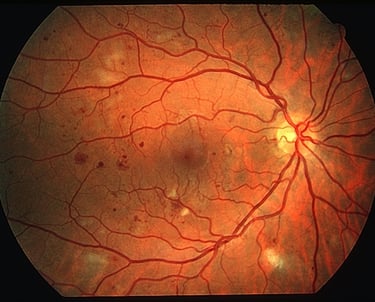 Diabetic Retinopathy