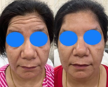 woman with forehead lines after treatment with toxin