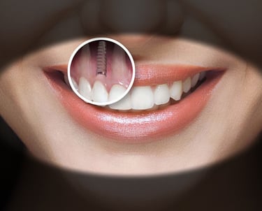 picture of a dental implant in the mouth