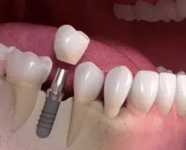 diagram of a dental implant