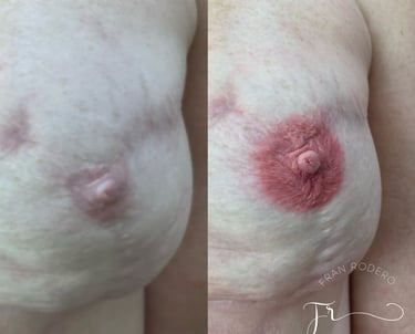 reconstrução de aréolas realistas após cirurgia de mastectomia