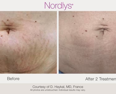 Scar & Stretch Mark Treatment in Hamilton, Ontario