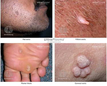 ultraplasma.com_wart_treatment_sigil_tedavisi_ultra_plasma_ultra_plazma_wart_plantar_flat_common