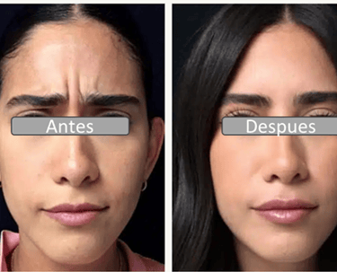 aplicacion botox ( toxina botulinica)