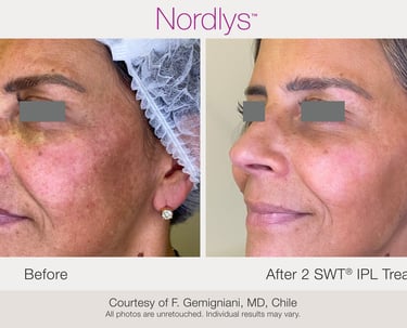 skin brightening and pigmentation correction treatment in Hamilton Ontario