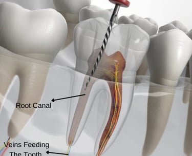 a image showing cleaning pulp in root canal treatment