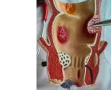 Analgesic properties: Honey relieves pain and itching associated with fissures and fistulas