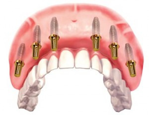 Puente fijo sobre implantes