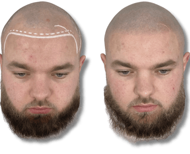 Before and after scalp micropigmentation for a natural-looking hairline and hair loss treatment.
