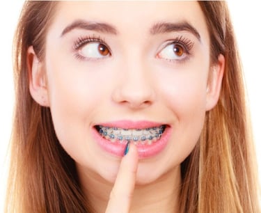 niềng răng bao lâu