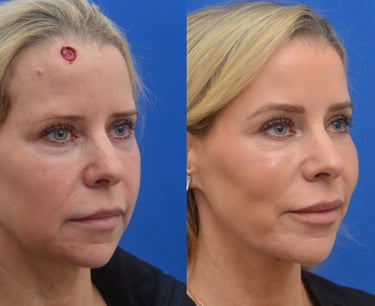 Mohs Surgery Duluth, GA