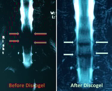 Cervical disc herniation MRI before and after Discogel injection