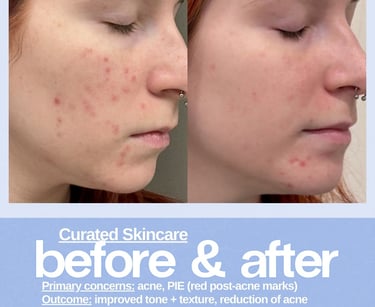 Before and after skincare results showing reduction in acne and red post-acne marks for improved skin texture.