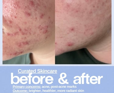 Before and after skincare results showing improvement in cystic acne and post-acne marks.