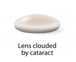 Image of a cloudy lens clouded with cataract.