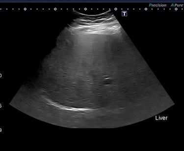 R/O Fatty liver ultrasounds in Luxury T & Ultrasoud Center, hialeah fl