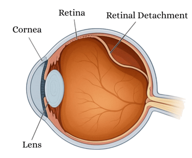 Cross-sectional diagram of an eye showing retinal detachment with cornea, lens, and retina labeled