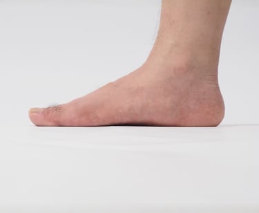 flat feet 