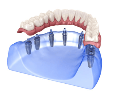 Dentita a Tirana Specializzati in riabilitazioni parziali, totali ed estreme