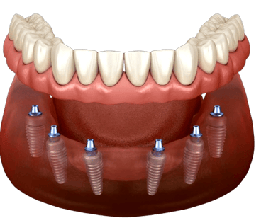 Dentista a Tirana Impianti Dentali Allon4