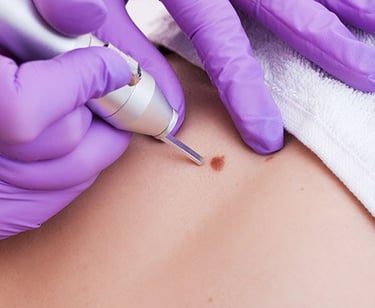 Achieve clear skin with top-notch mole removal and skin tag removal treatments in Vadodara.