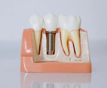 Implantes dentales en Sevilla
