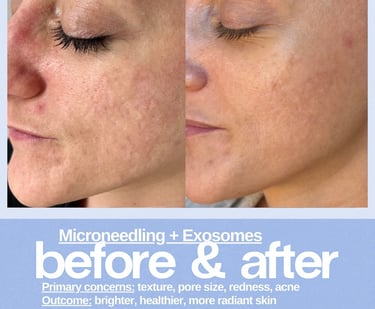 Microneedling and exosomes before and after results showing improved skin texture and reduced acne redness.
