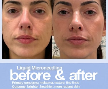 Before and after liquid microneedling treatment results for melasma, skin texture, and fine lines.