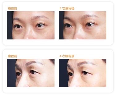 BTL眼部成效見證