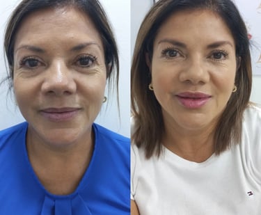 Botox near me, Escazu, Costa Rica