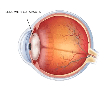 image of eye anatomy diagram showing cataractous lens