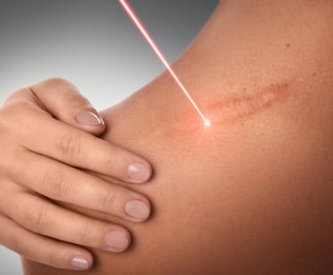 close up of red laser beam on scar for skin treatment